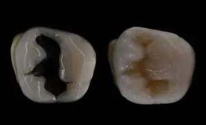 Dental amalgam before and after replacement