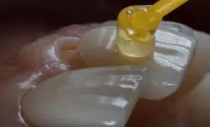 Porcelain Veneers