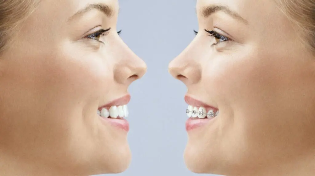 Braces vs Invisaling