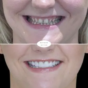 Porcelain Veneer results