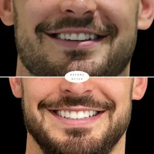 Composite Bonding results
