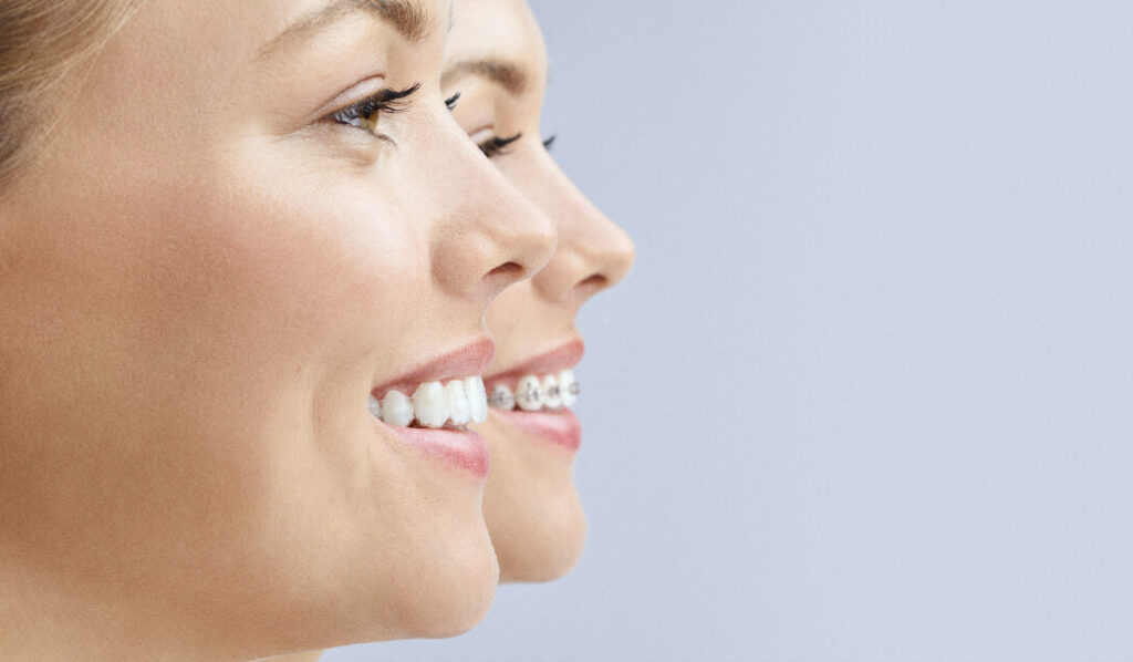 Is Invisalign as efficient as traditional braces for adults
