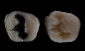 Dental amalgam before and after replacement