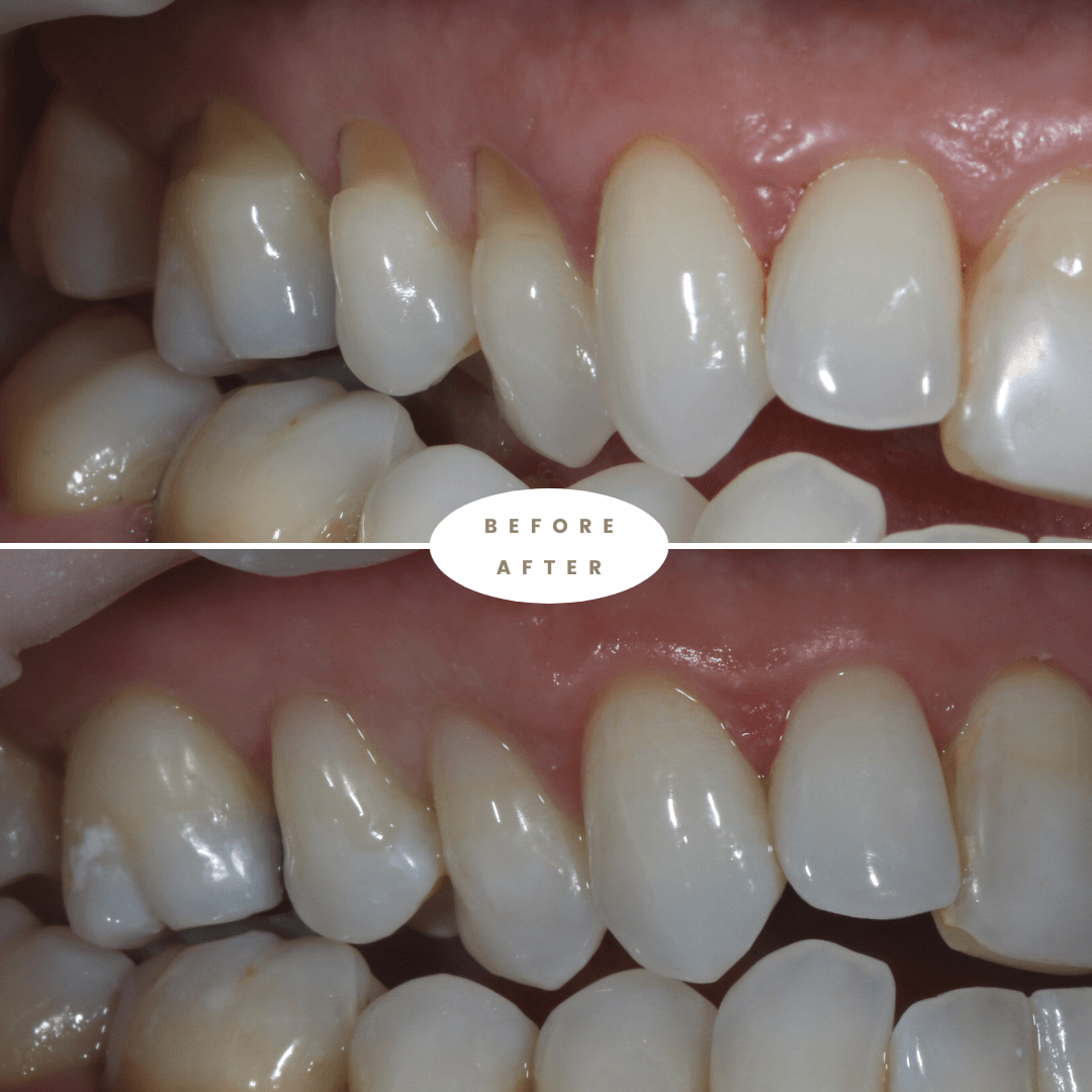 Composite Bonding in Sydney Composite & Dental Bonding