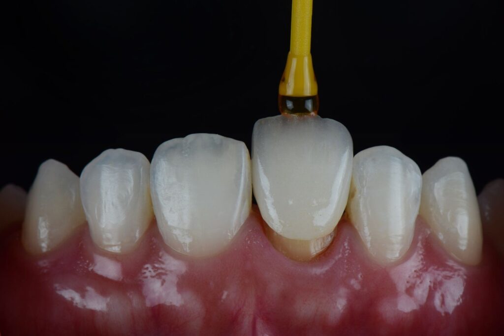 cementation (third appointment)