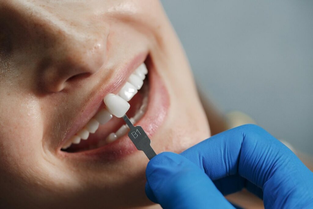 Dental Veneers Cost Sydney