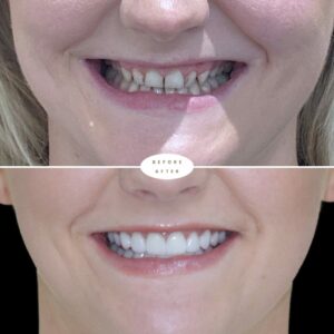 Porcelain Veneer results