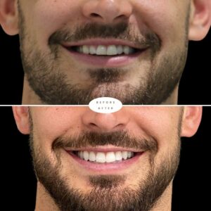 Composite Bonding results